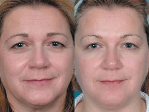 Photos before and after plasma rejuvenation