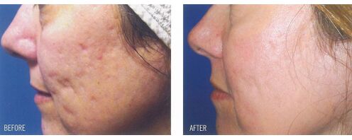 Before and after applying laser equipment to scarred skin