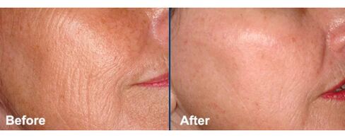 Facial skin before and after laser rejuvenation surgery