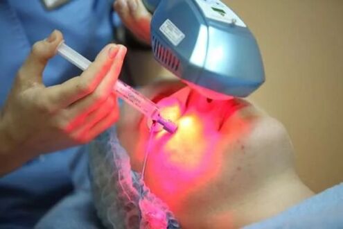 Facial skin laser bioactivation