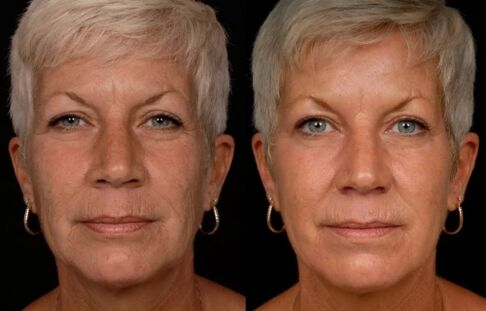 Results of facial skin laser treatment-reduce wrinkles