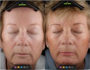 Before and after segmented laser revitalization