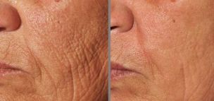 Photos before and after skin rejuvenation