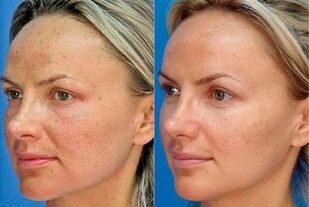 Photos before and after using the device for skin rejuvenation